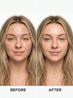 Gel Cleanser for Acne-Prone Skin